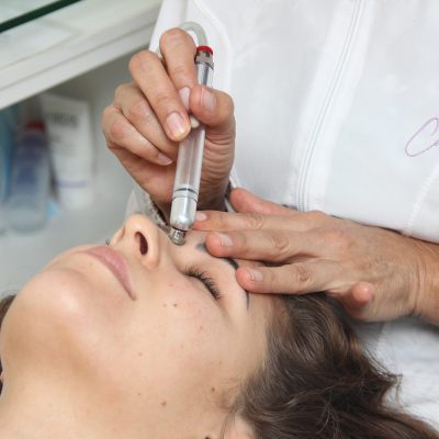 Microdermoabrasión